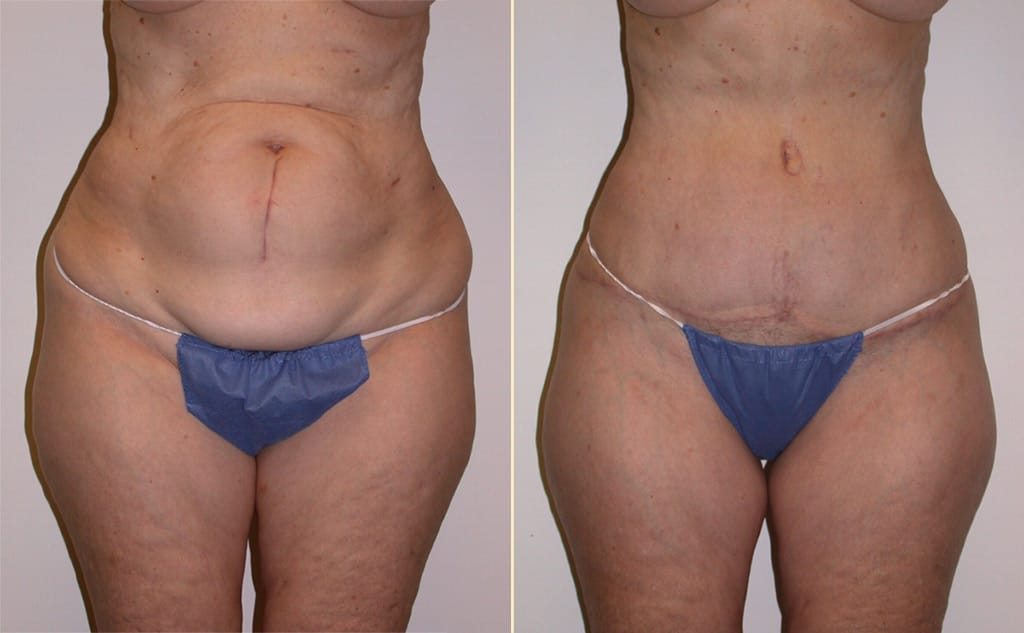 Tummy Tuck