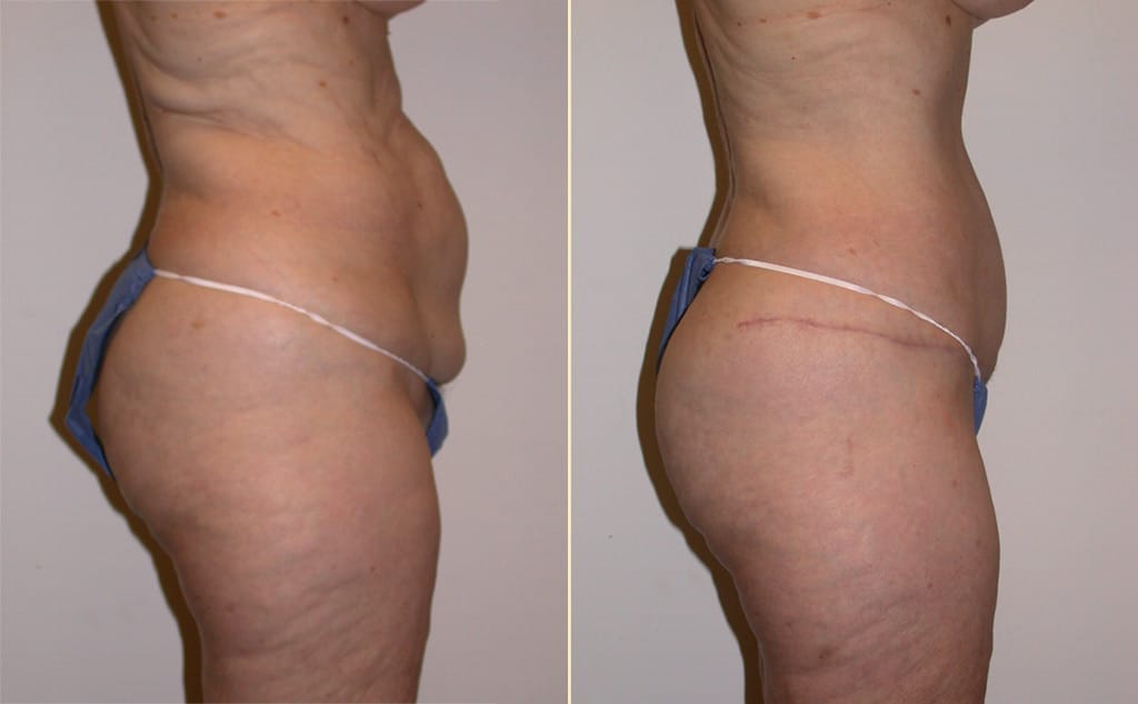 abdominoplasty-30411c-movassaghi-
