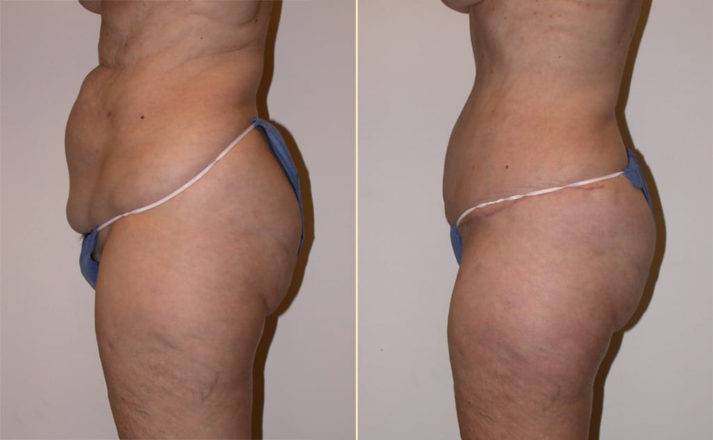 abdominoplasty-30411c2-movassaghi-