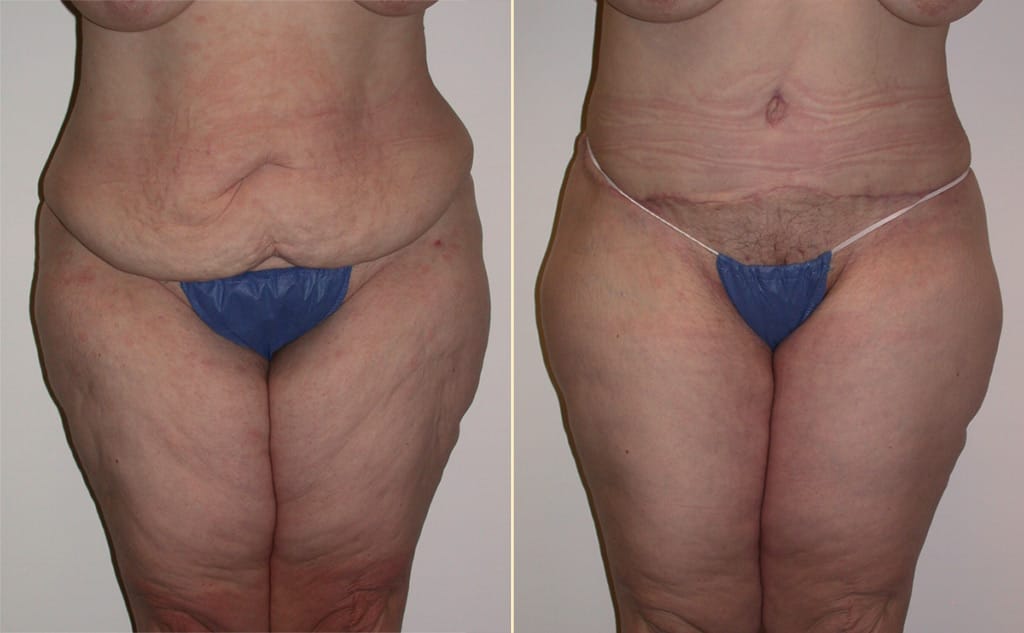 Tummy Tuck