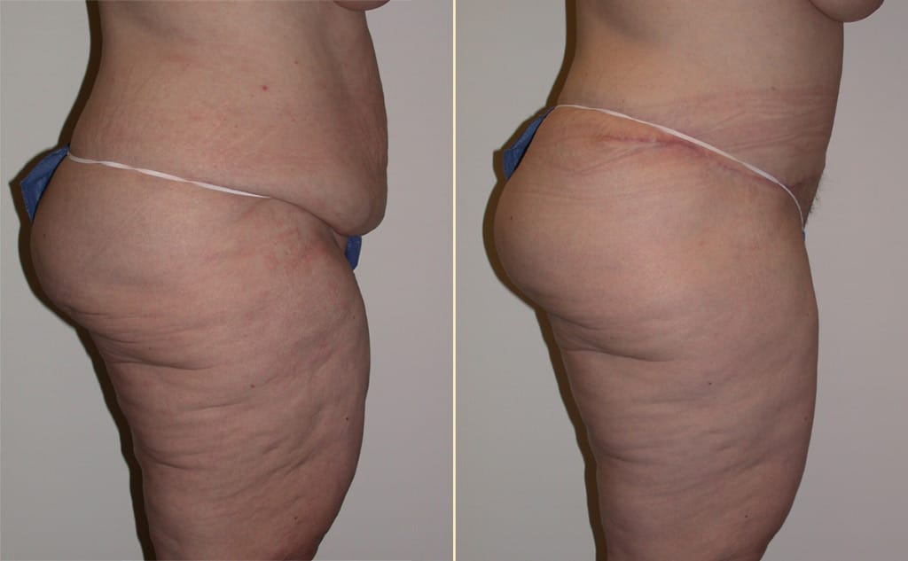 abdominoplasty-30414c-movassaghi-