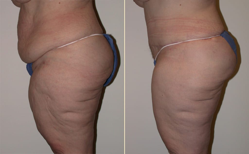 abdominoplasty-30414c2-movassaghi-