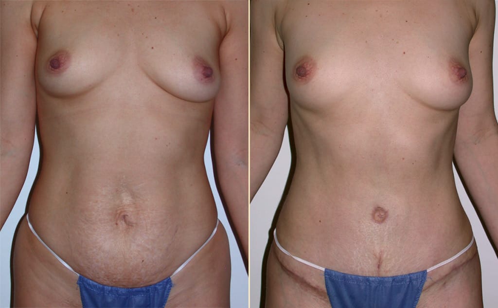 Tummy Tuck