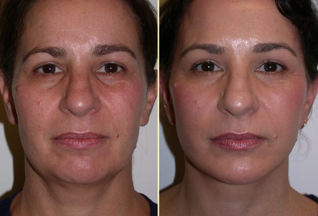 Chin Implant and Neck Lift