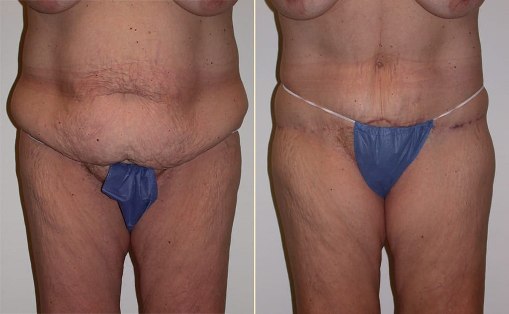 Tummy Tuck