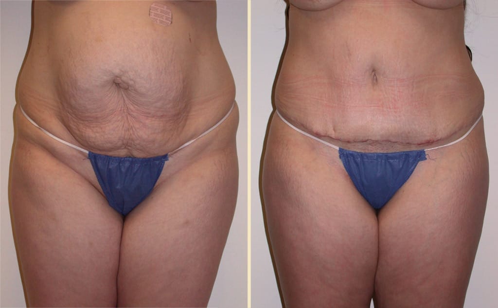 Tummy Tuck with Liposuction