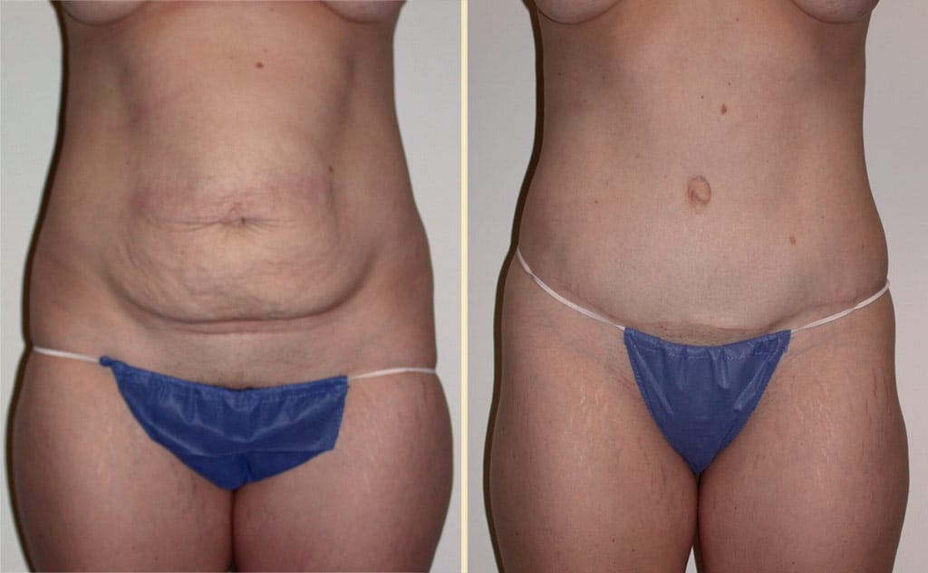 Abdominoplasty