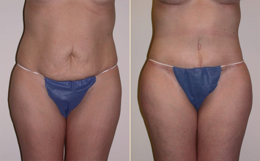 Tummy Tuck with Liposuction
