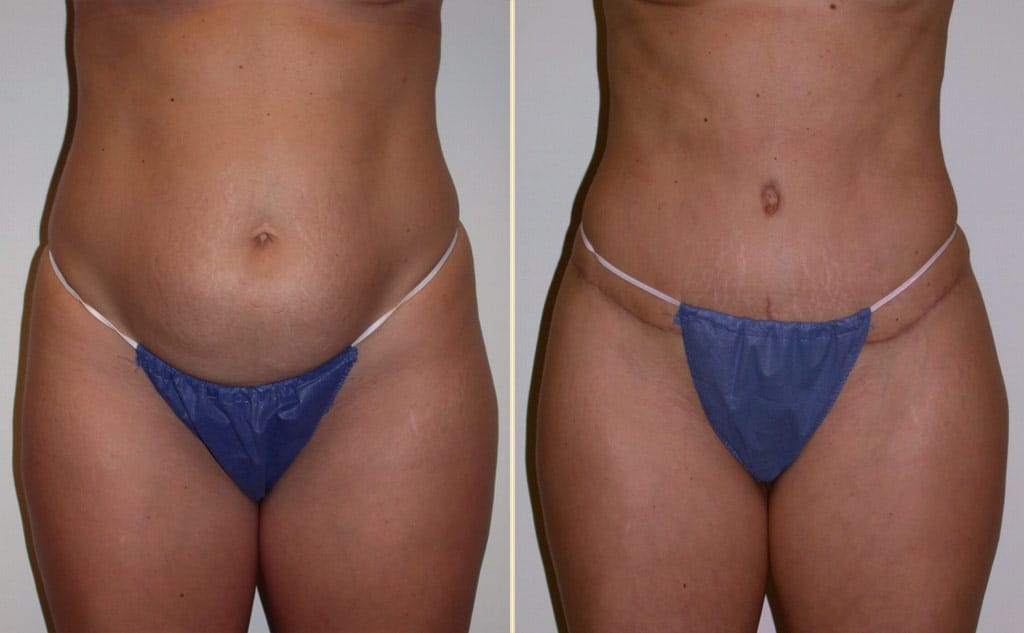Abdominoplasty with Liposuction