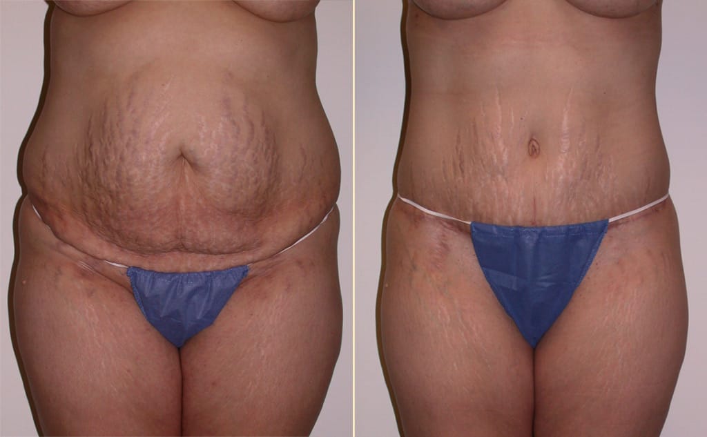 Tummy Tuck with Liposuction