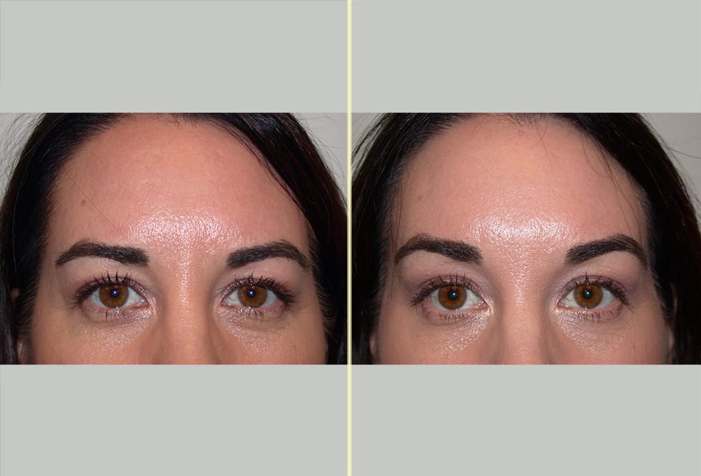 Brow Lift