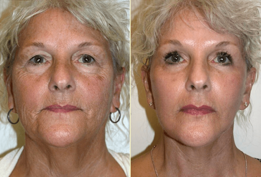 Before and after a facelift, brow lift, and eyelid lift with Dr. Kiya Movassaghi