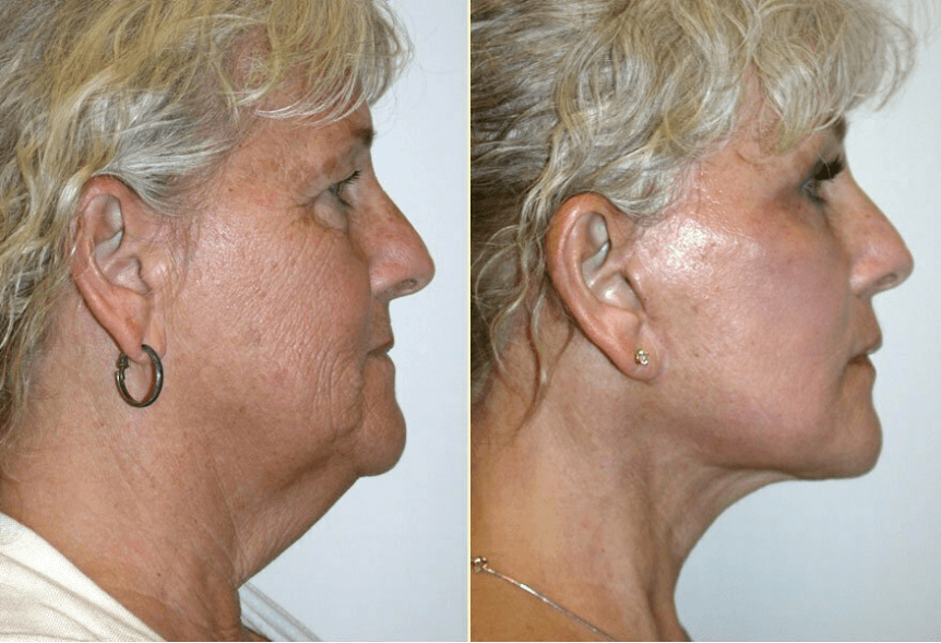Before and after a facelift, brow lift, and eyelid lift with Dr. Kiya Movassaghi