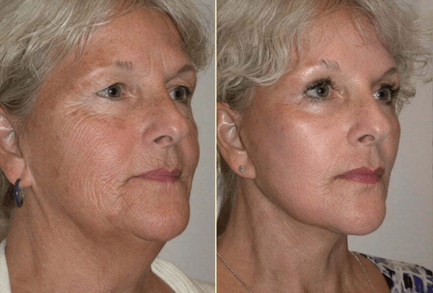 Before and after a facelift, brow lift, and eyelid lift with Dr. Kiya Movassaghi