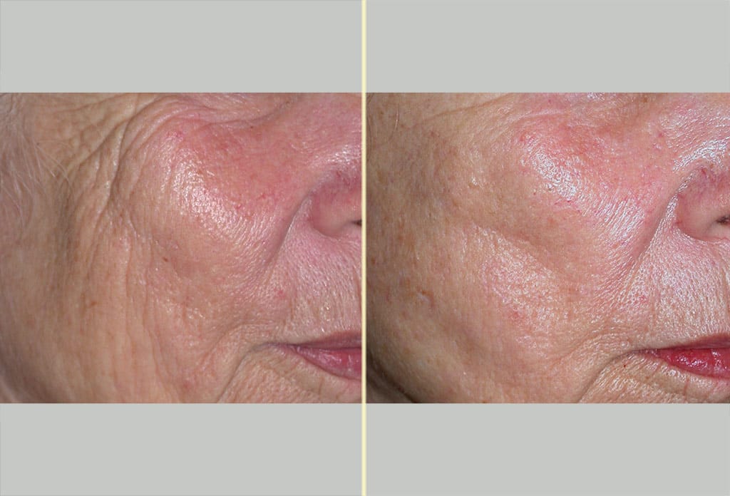Laser Skin Resurfacing