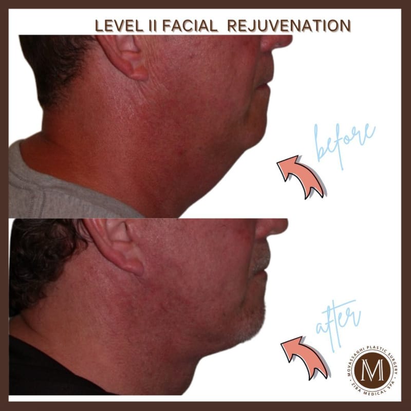 Male patient shown before and after level 2 facial rejuvenation with Dr. Kiya Movassaghi