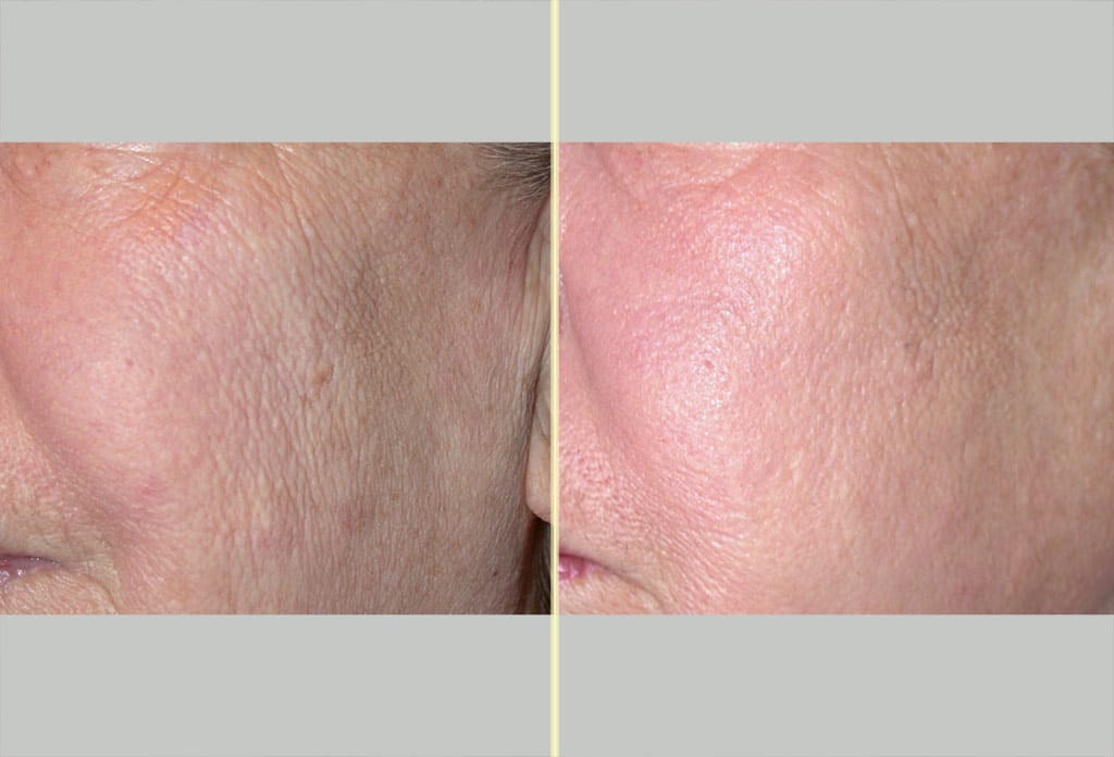 Laser Skin Resurfacing