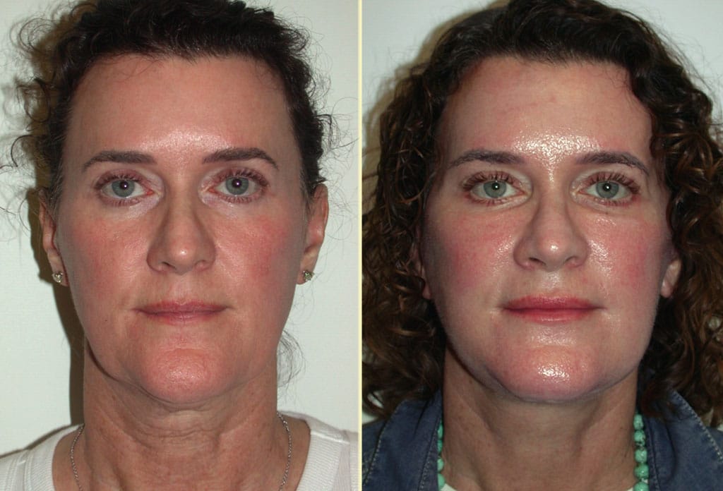 Facelift multiple procedures