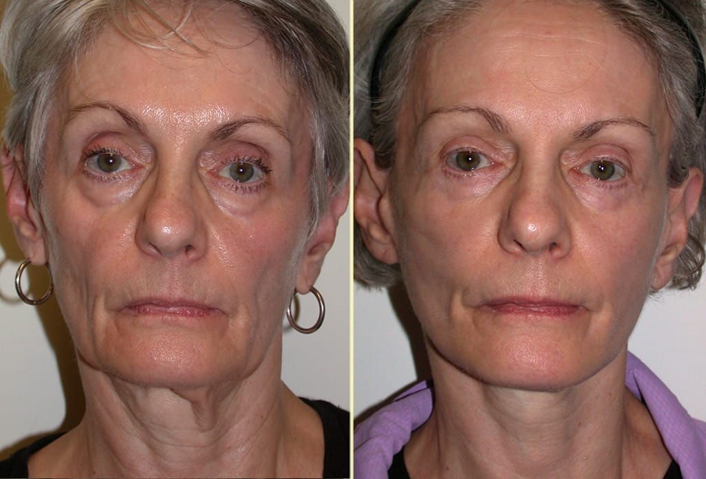 facelift-multiple-procedures