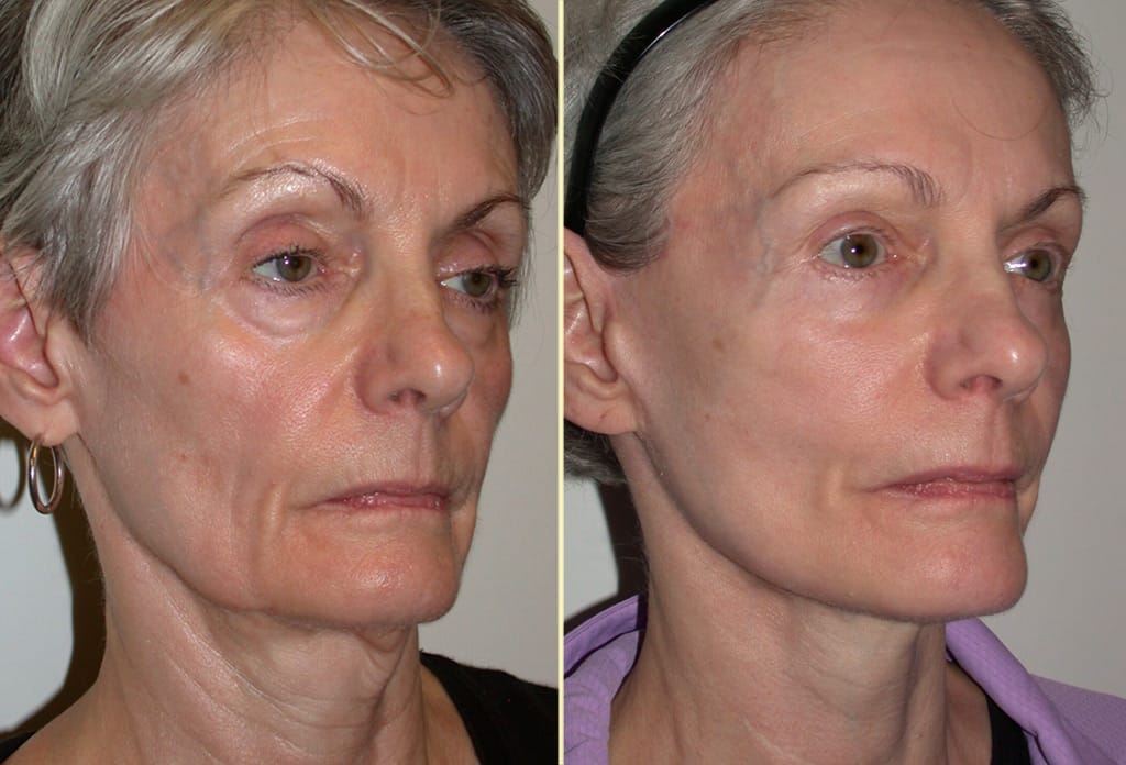 facelift-browlift-necklift-eyelidlift-31070b-movassaghi