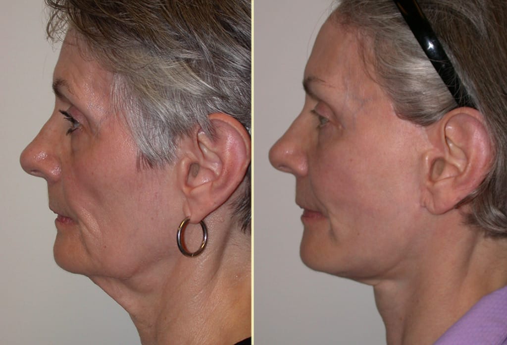facelift-browlift-necklift-eyelidlift-31070c-movassaghi